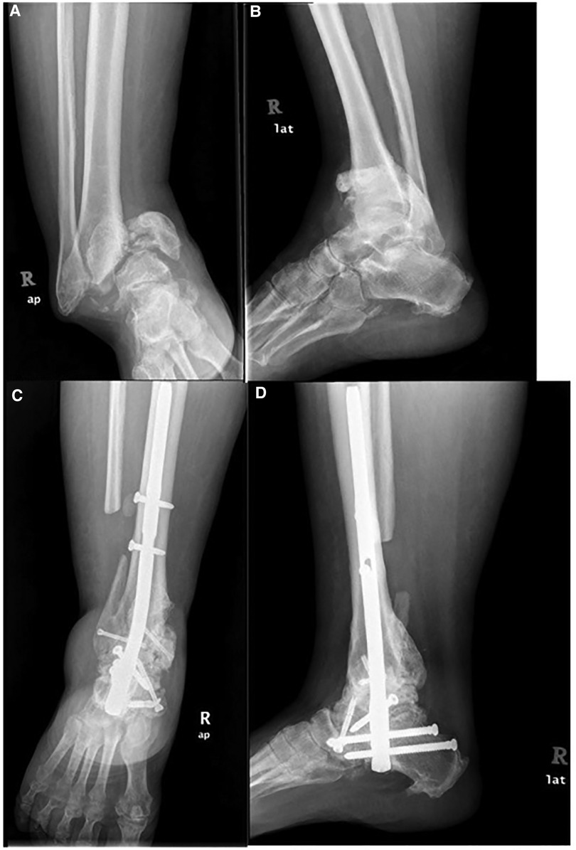 Implantology of Fractures of the Shaft of the Tibia Including Segmental  Fractures | SpringerLink