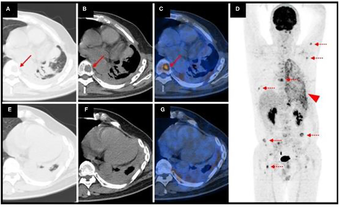 Frontiers Case Report 18f Fdg Petct Demonstrating Malignant Spread