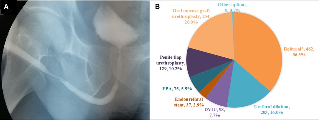 Severe Urethral Stenosis/Complete Urethral Obliteration