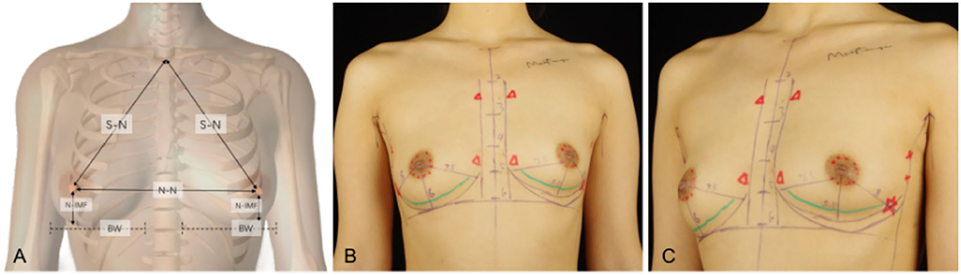 The breast implant–induced increase of the N-IMF/LVC distance is