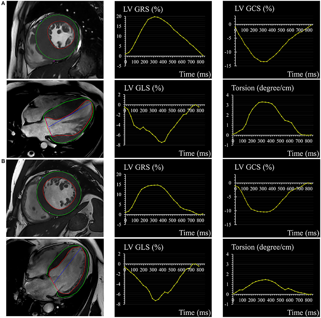 Frontiers  Evaluation of left ventricular myocardial stratified
