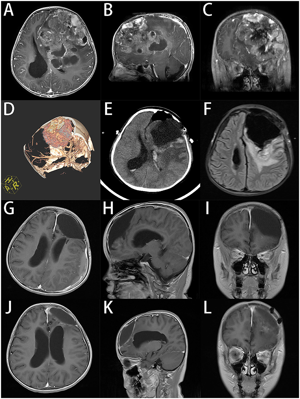 Frontiers Giant Pediatric Supratentorial Tumor Clinical Feature And Surgical Strategy 6908