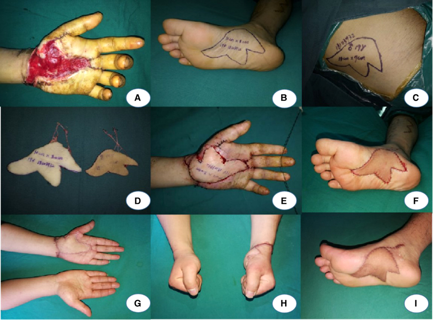 Soft tissue injury recovery - GC Hand Therapy