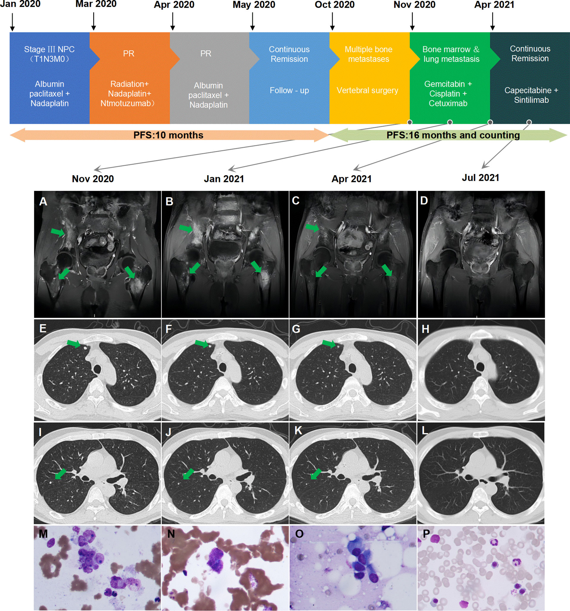 frontiers-treatment-strategy-of-metastatic-nasopharyngeal-carcinoma