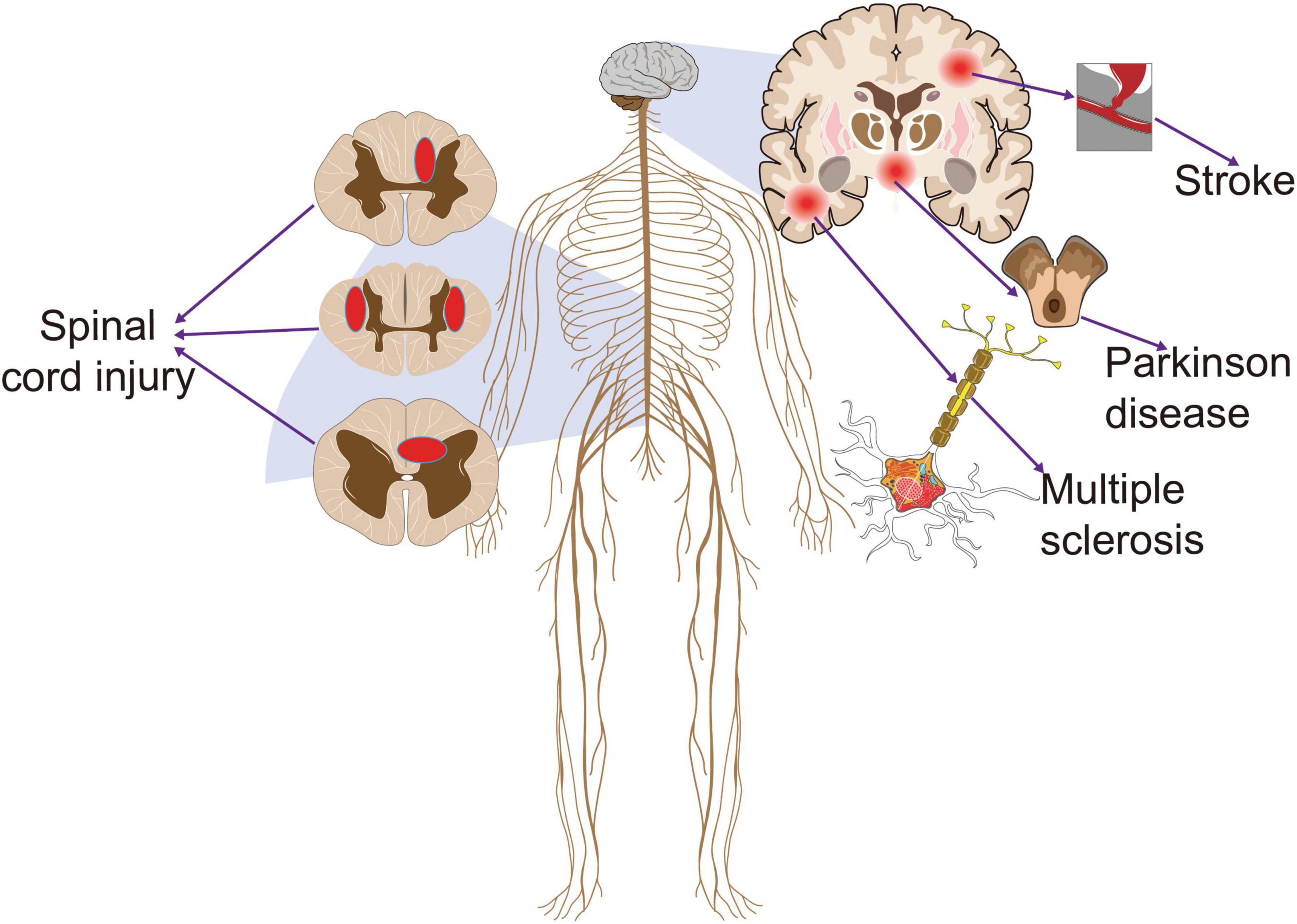 Frontiers Non invasive Brain Stimulation For Central Neuropathic Pain