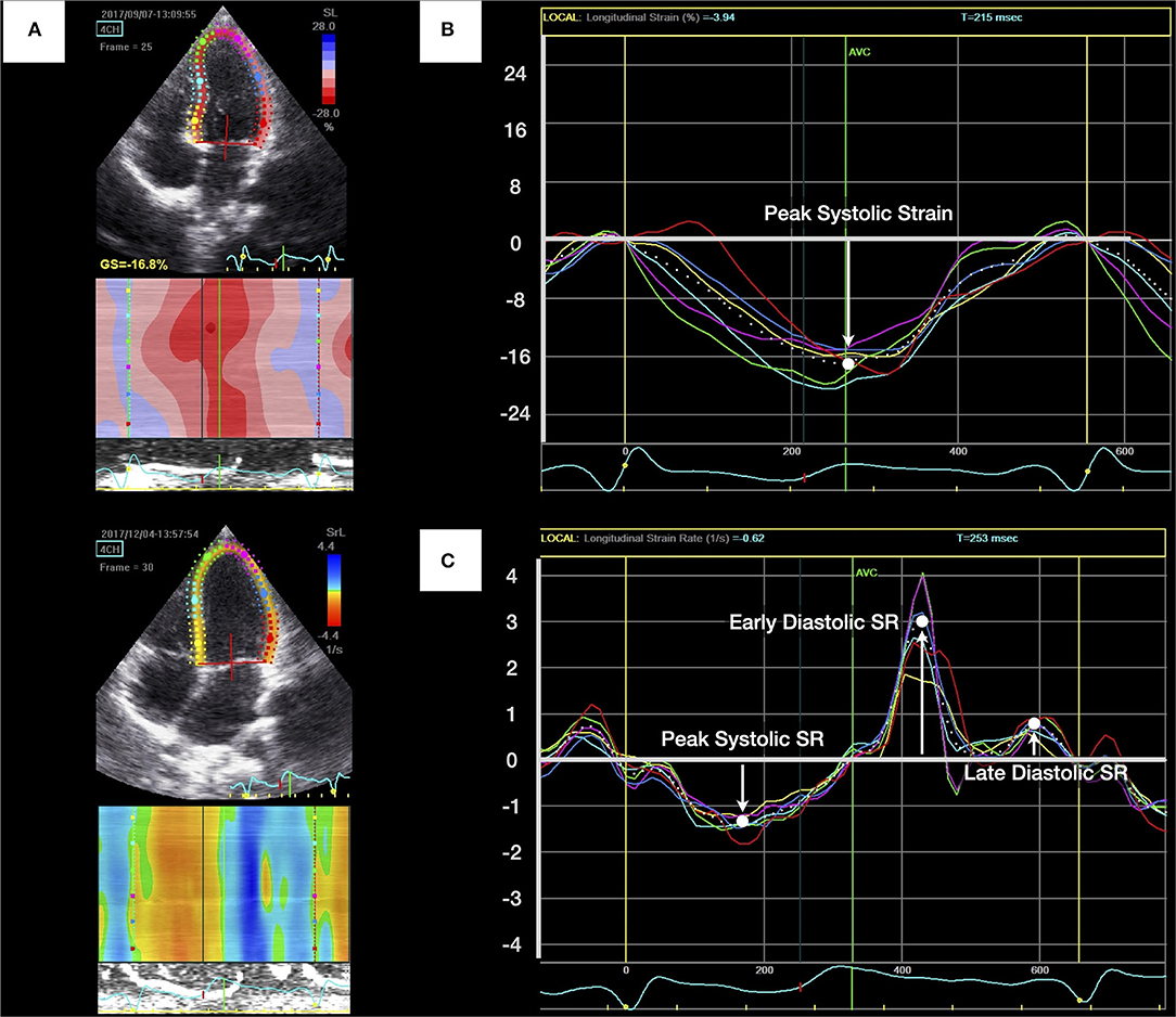 Evaluation of Subclinical LV Systolic Dysfunction by GLS Using 2D-STE