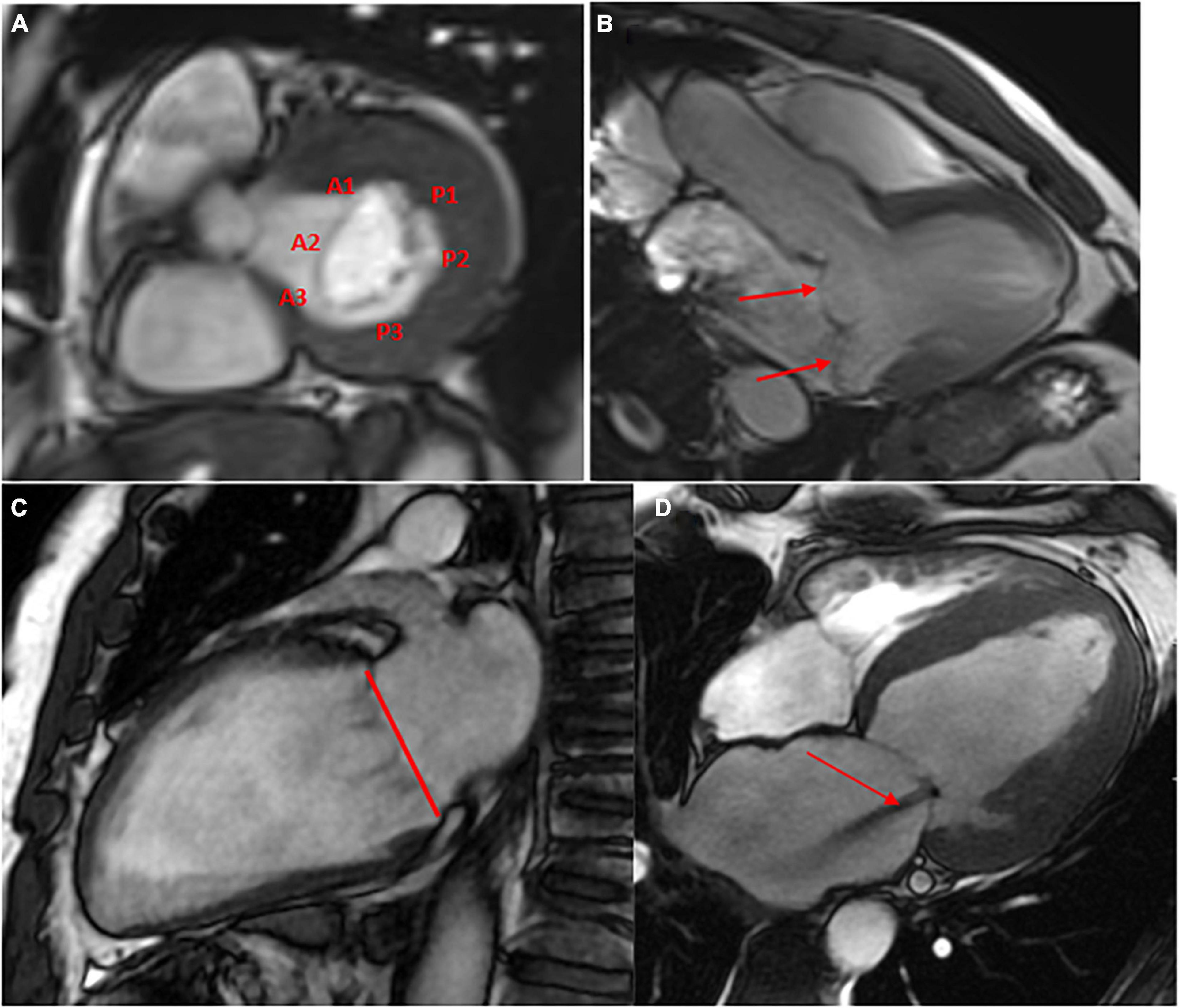 Direct mitral regurgitation quantification in hypertrophic cardiomyopathy  using 4D flow CMR jet tracking: evaluation in comparison to conventional  CMR, Journal of Cardiovascular Magnetic Resonance