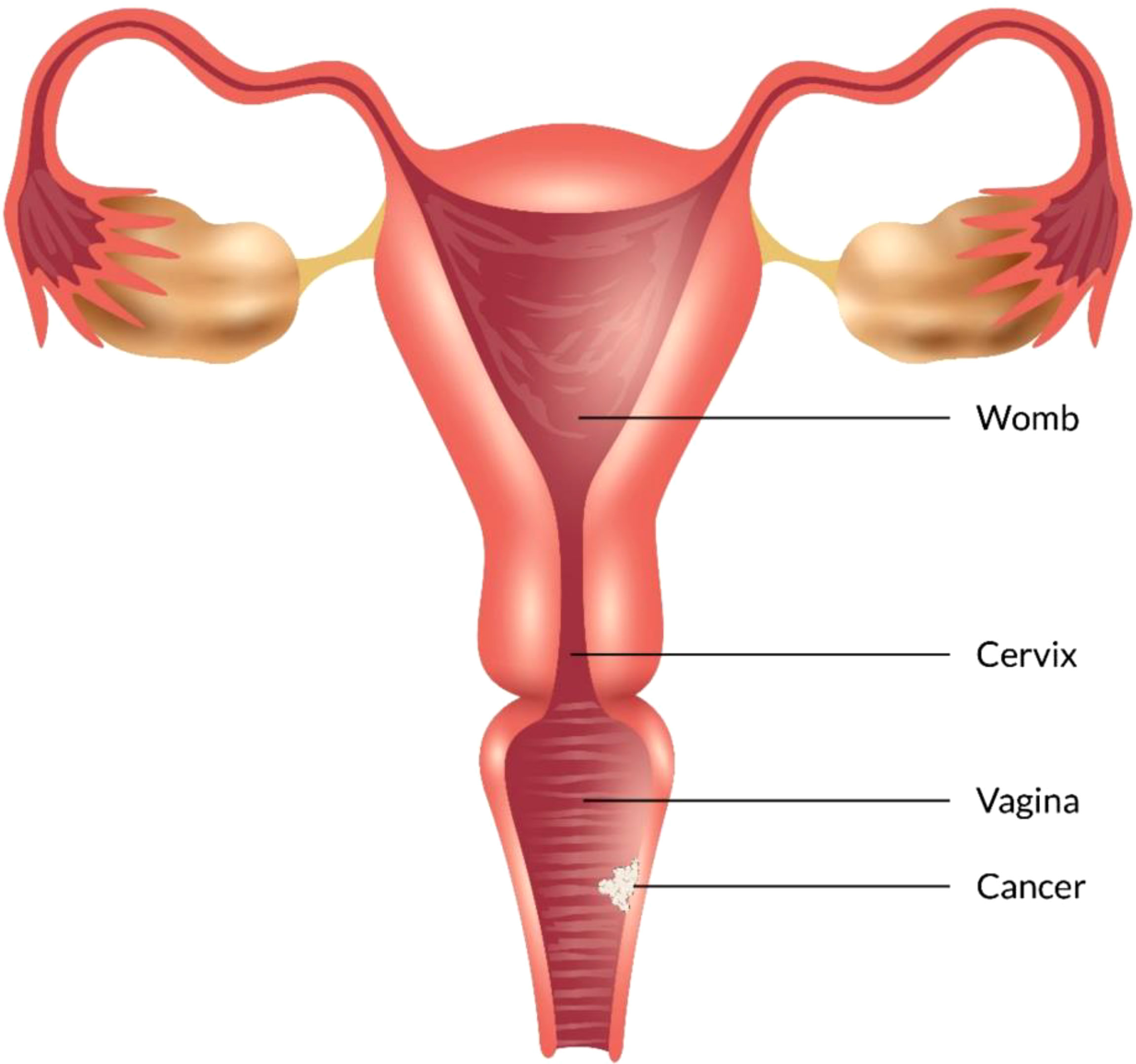 Cancer de vagina y vulva