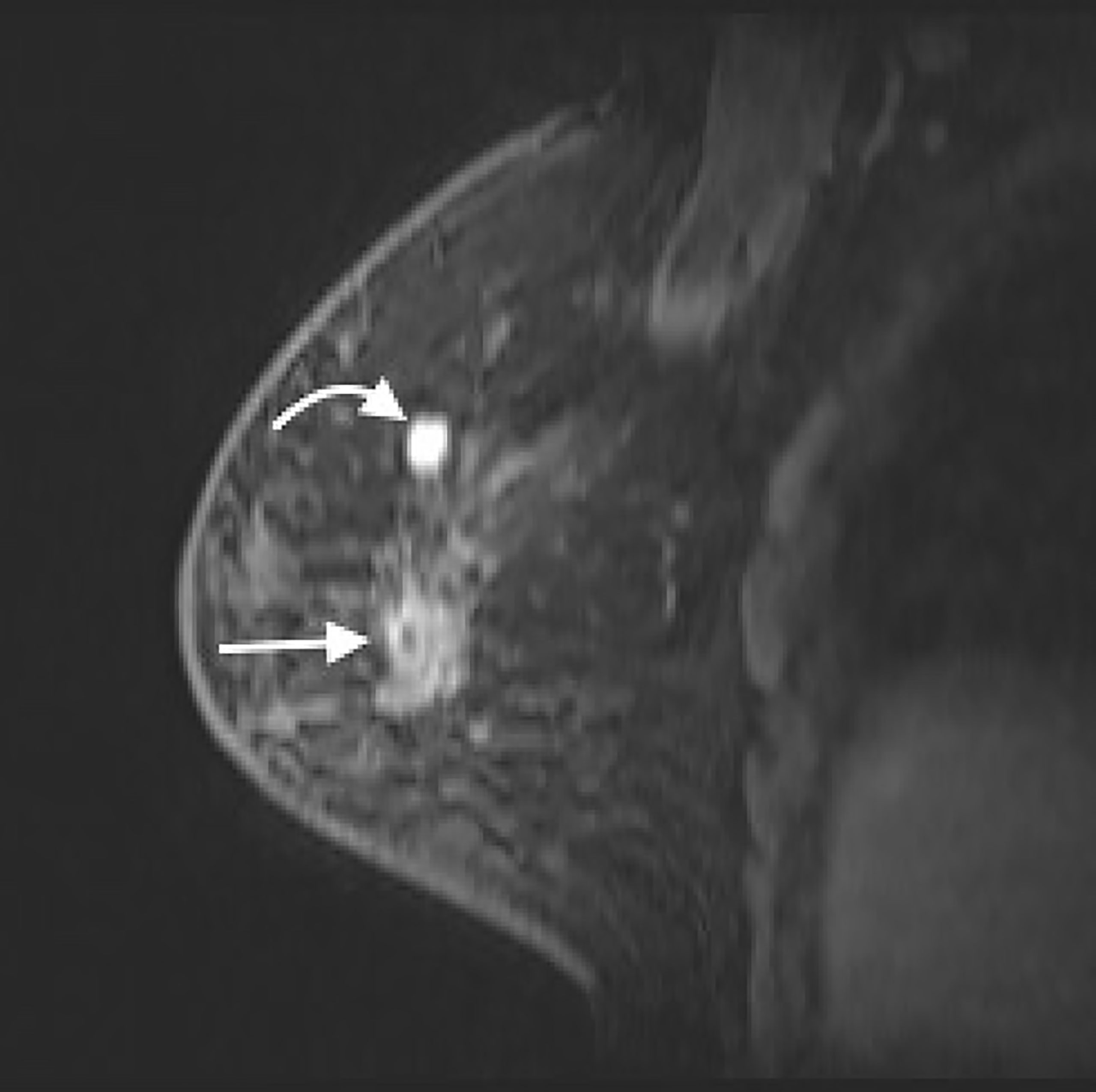 Frontiers  A case report of breast cancer in silicone-injected breasts  diagnosed by an emerging technique of contrast-enhanced mammography-guided  biopsy