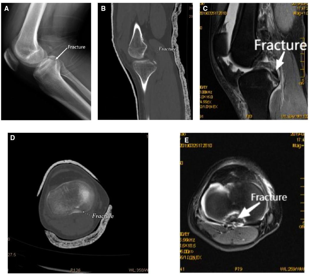 Frontiers | Treatment Of Avulsion Fracture Of Posterior Cruciate ...