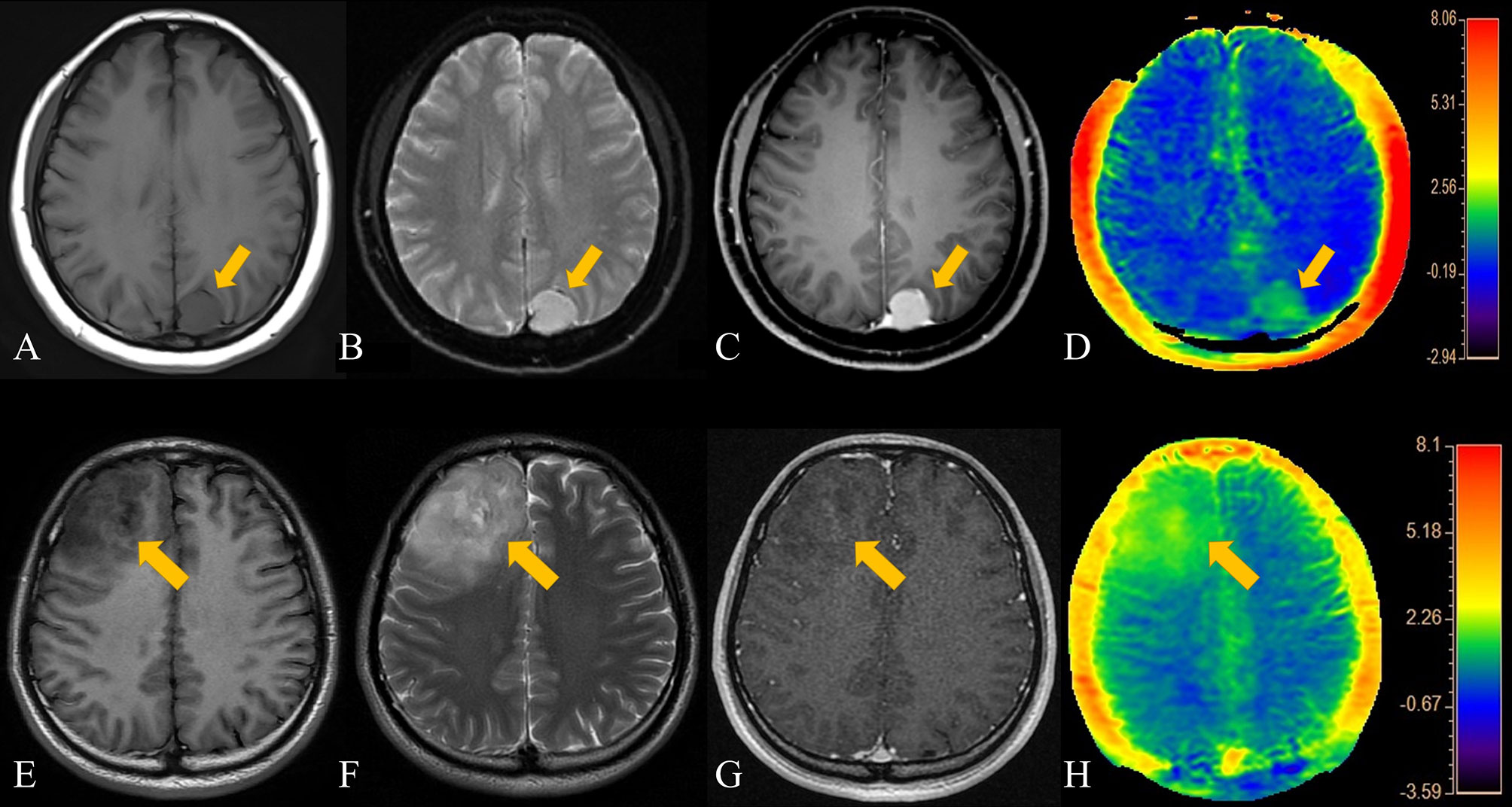 Frontiers Differentiation Of Meningiomas And Gliomas By Amide Proton Transfer Imaging A 3420