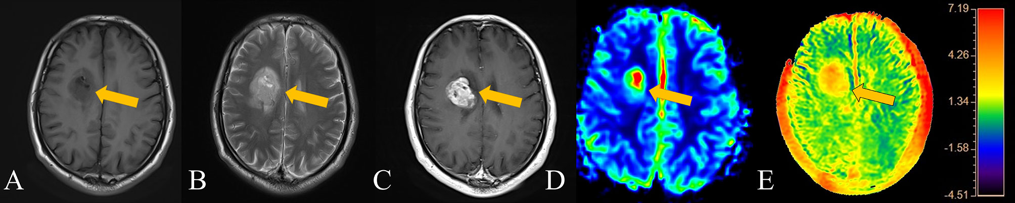 Frontiers Differentiation Of Meningiomas And Gliomas By Amide Proton Transfer Imaging A 