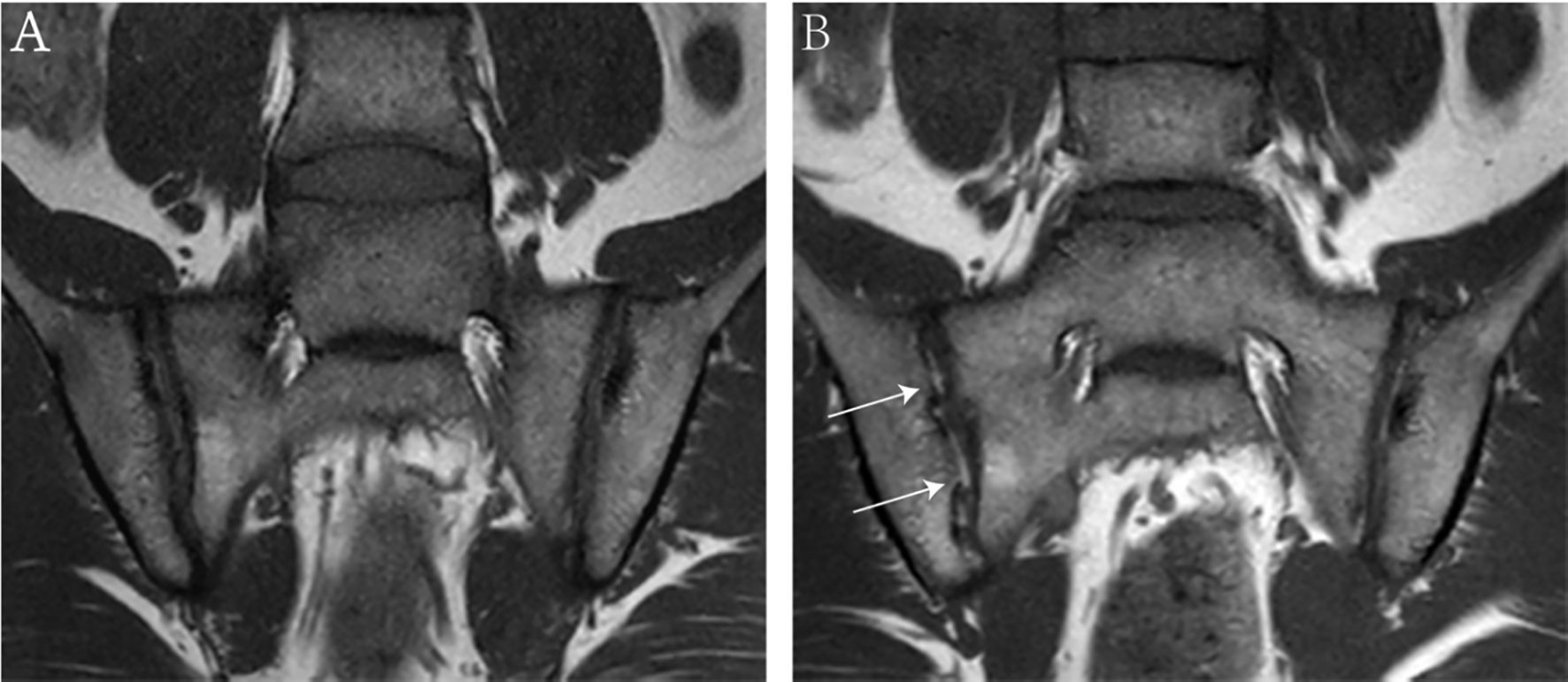 Frontiers | Baseline Severity of Sacroiliitis and Extensive Fat ...