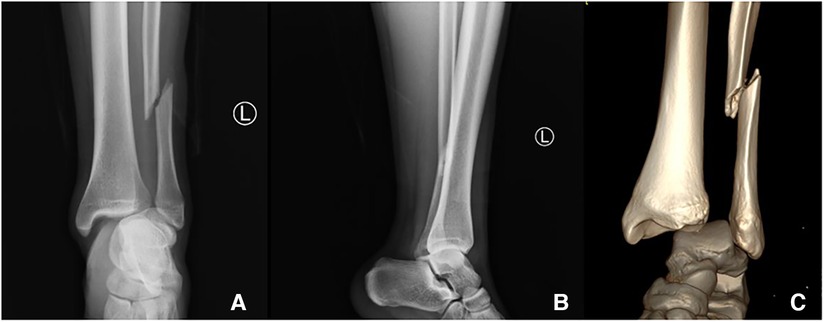 Malunited fracture - tibia, Radiology Case