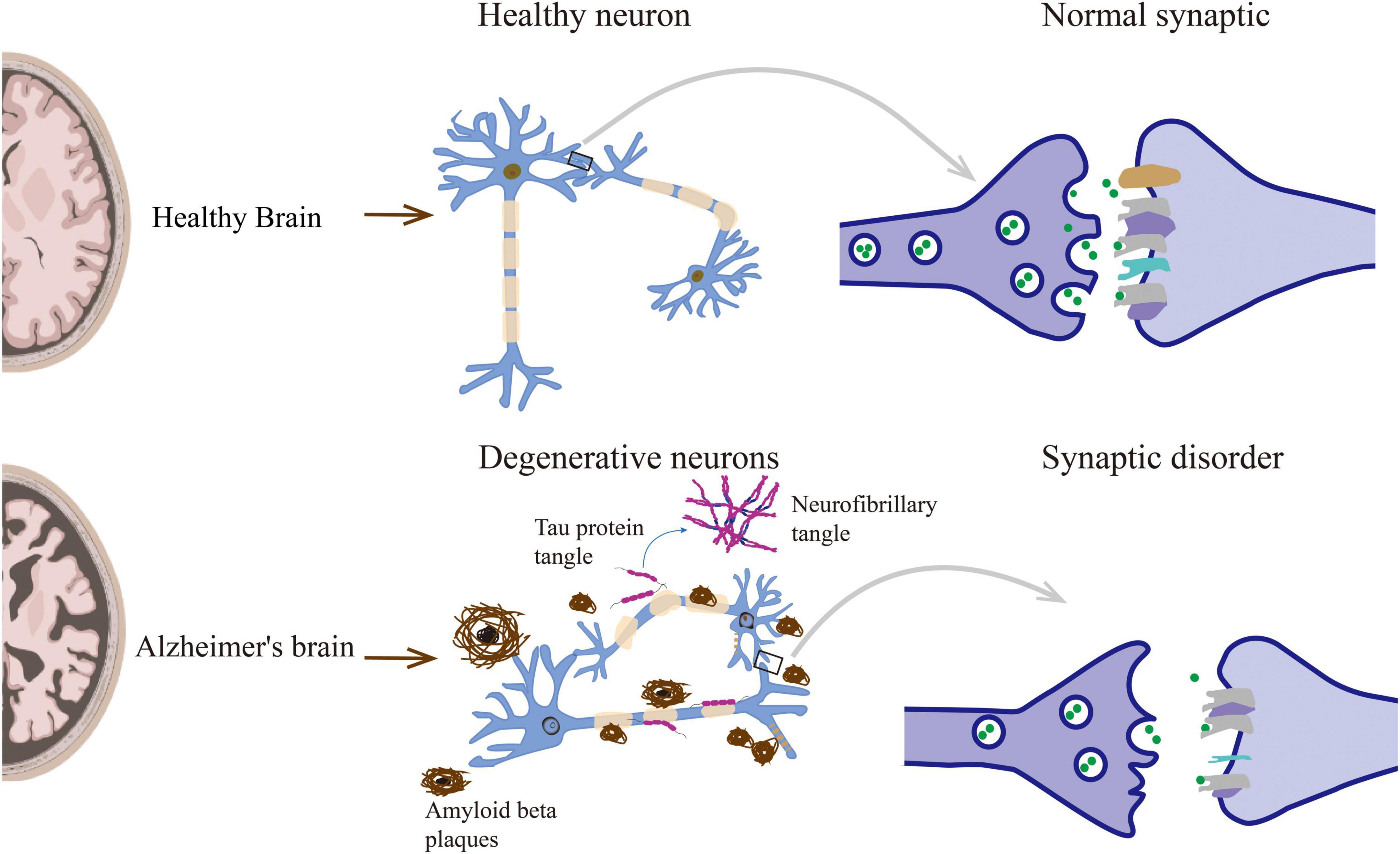 Frontiers  Epigenetics in Alzheimer's Disease