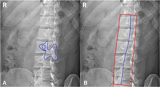 lumbar spine xray abnormal