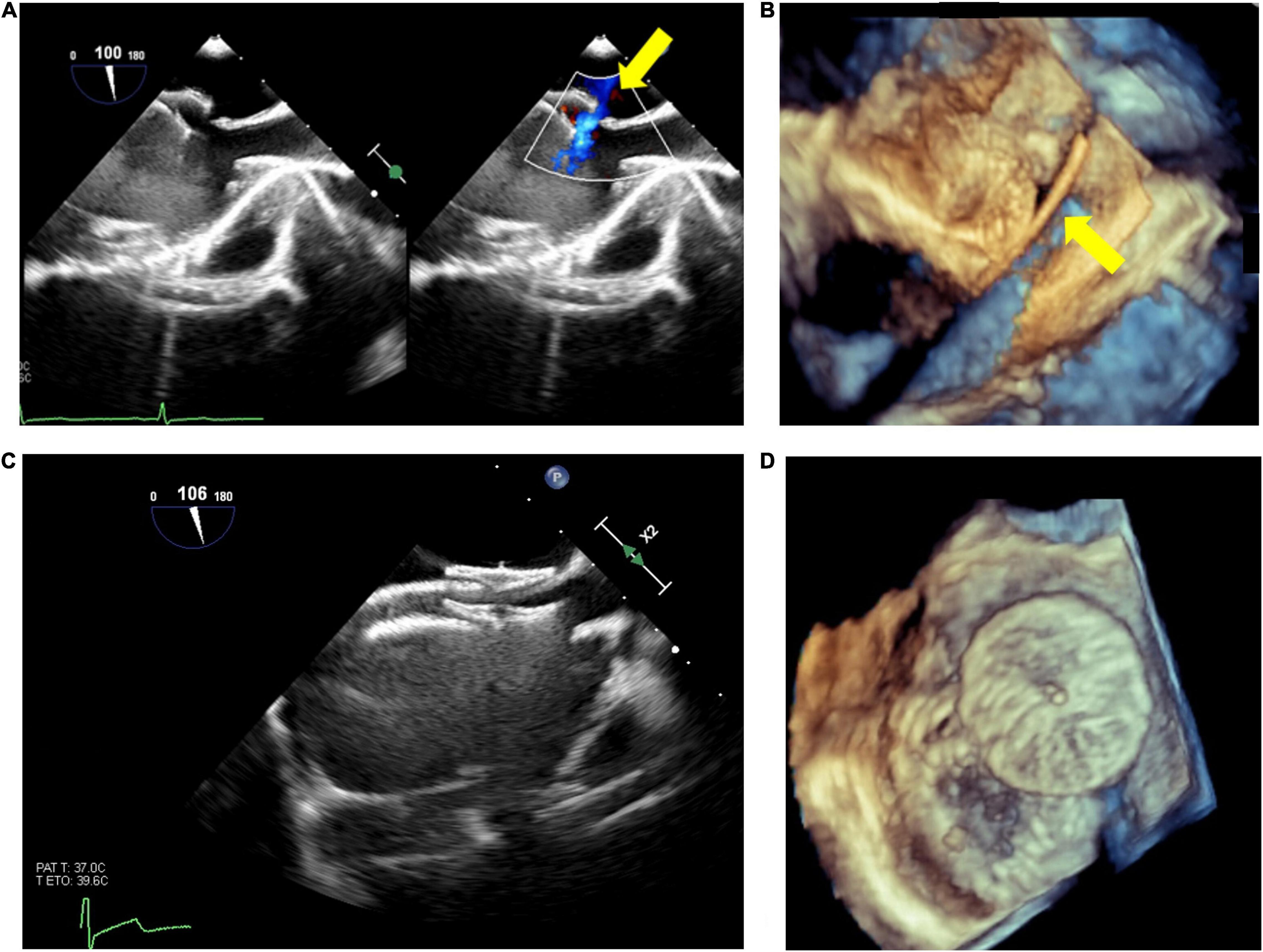 Transthoracic Echocardiographic Images Obtained after Cardiac  Catheterization 