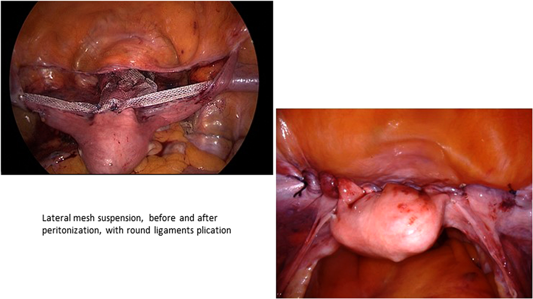 Cystocele (prolapsed bladder) - Pelvic organ prolapse - stage 0 to 4