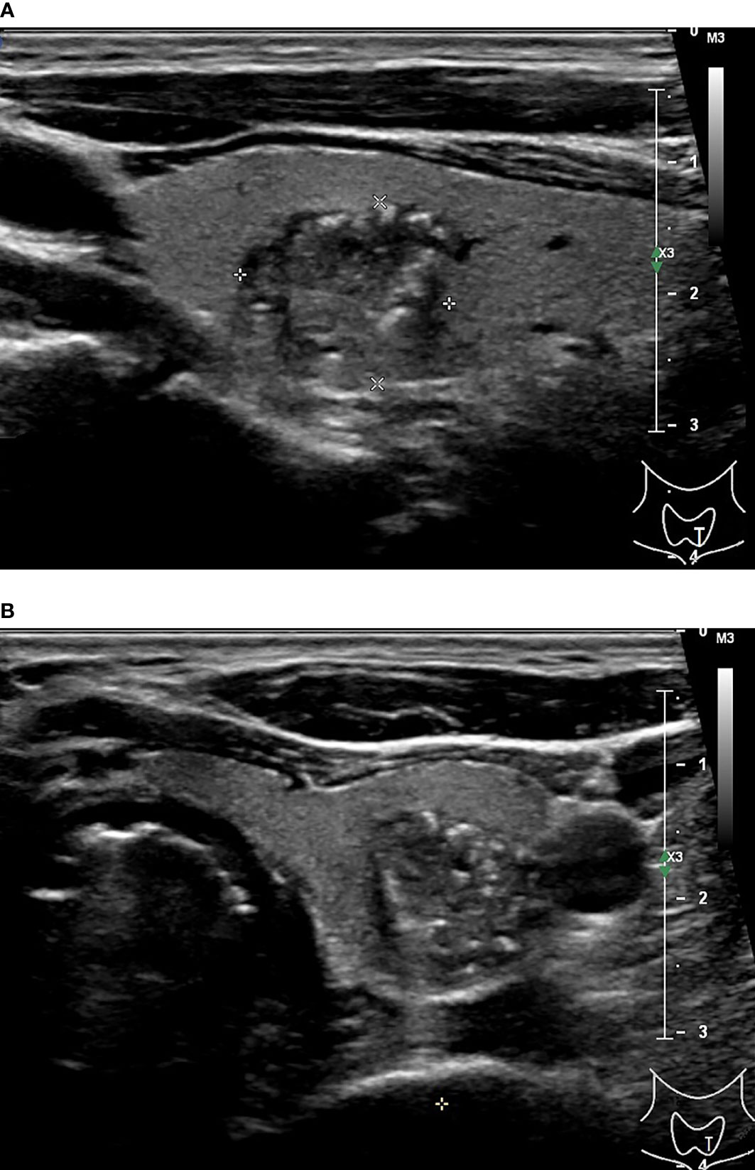 Frontiers Validating And Comparing C Tirads K Tirads And Acr Tirads In Stratifying The 