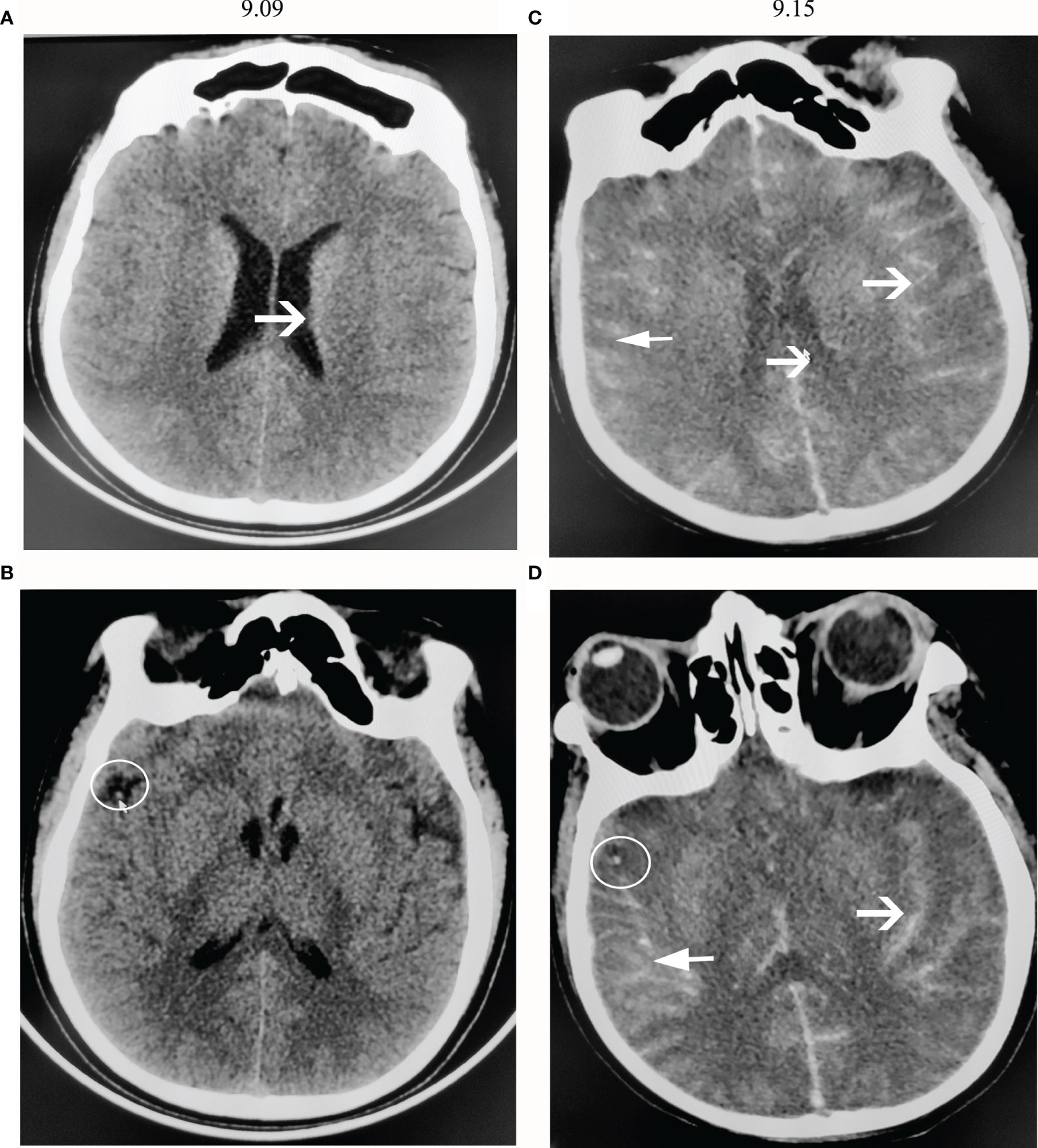 Naegleria Fowleri Brain