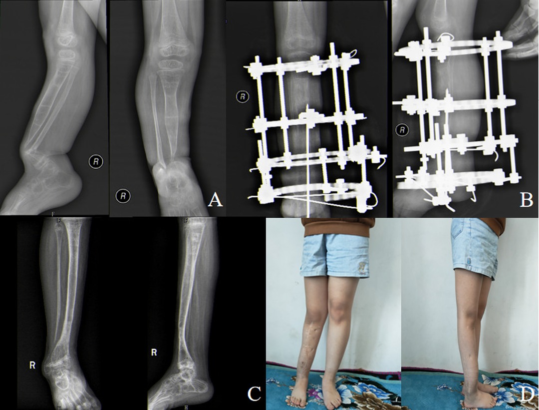 Cureus, Congenital Pseudoarthrosis of Tibia With Anterolateral Bowing  Treated With Ilizarov Ring Fixator: A Case Report