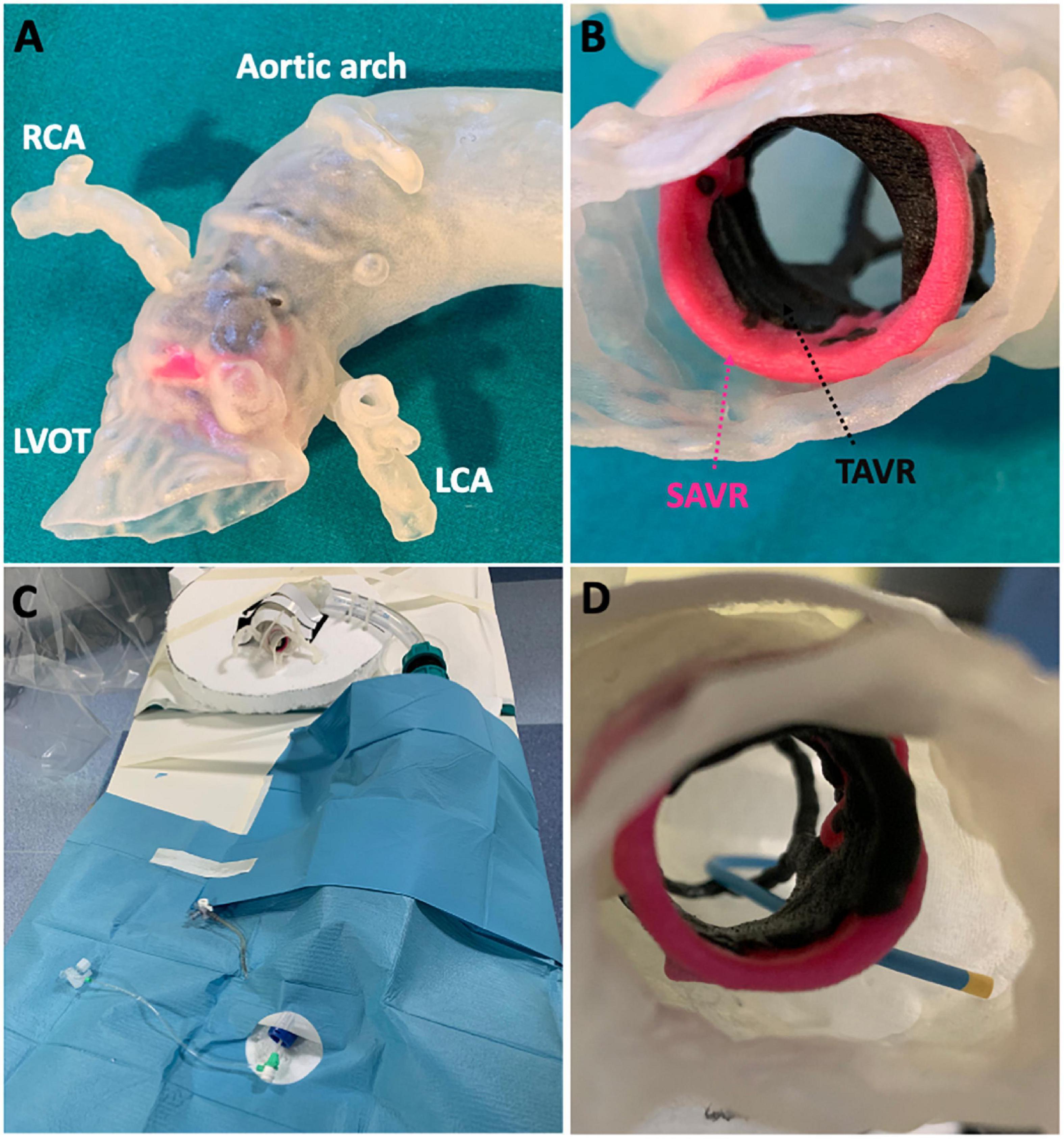 Frontiers Coronary access following ACURATE neo implantation for transcatheter aortic valve-in-valve implantation Ex vivo analysis in patient-specific anatomies