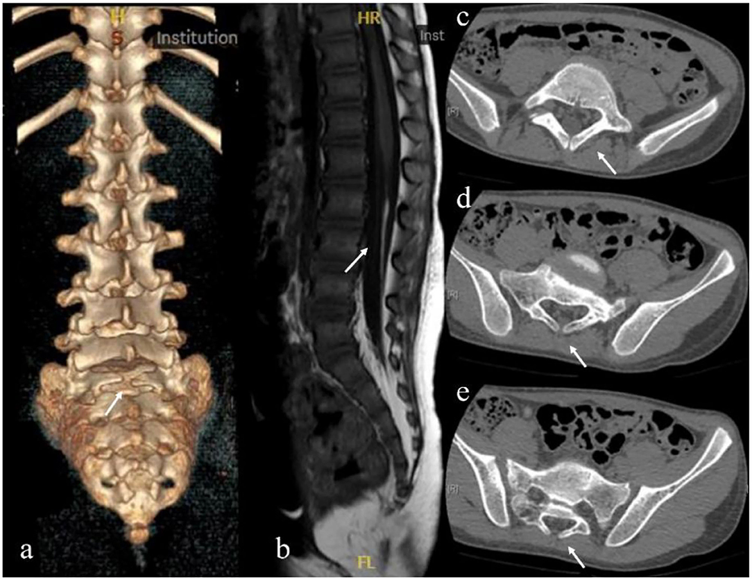 Frontiers Spina Bifida Occulta Is A Risk Factor For Spinal Cord