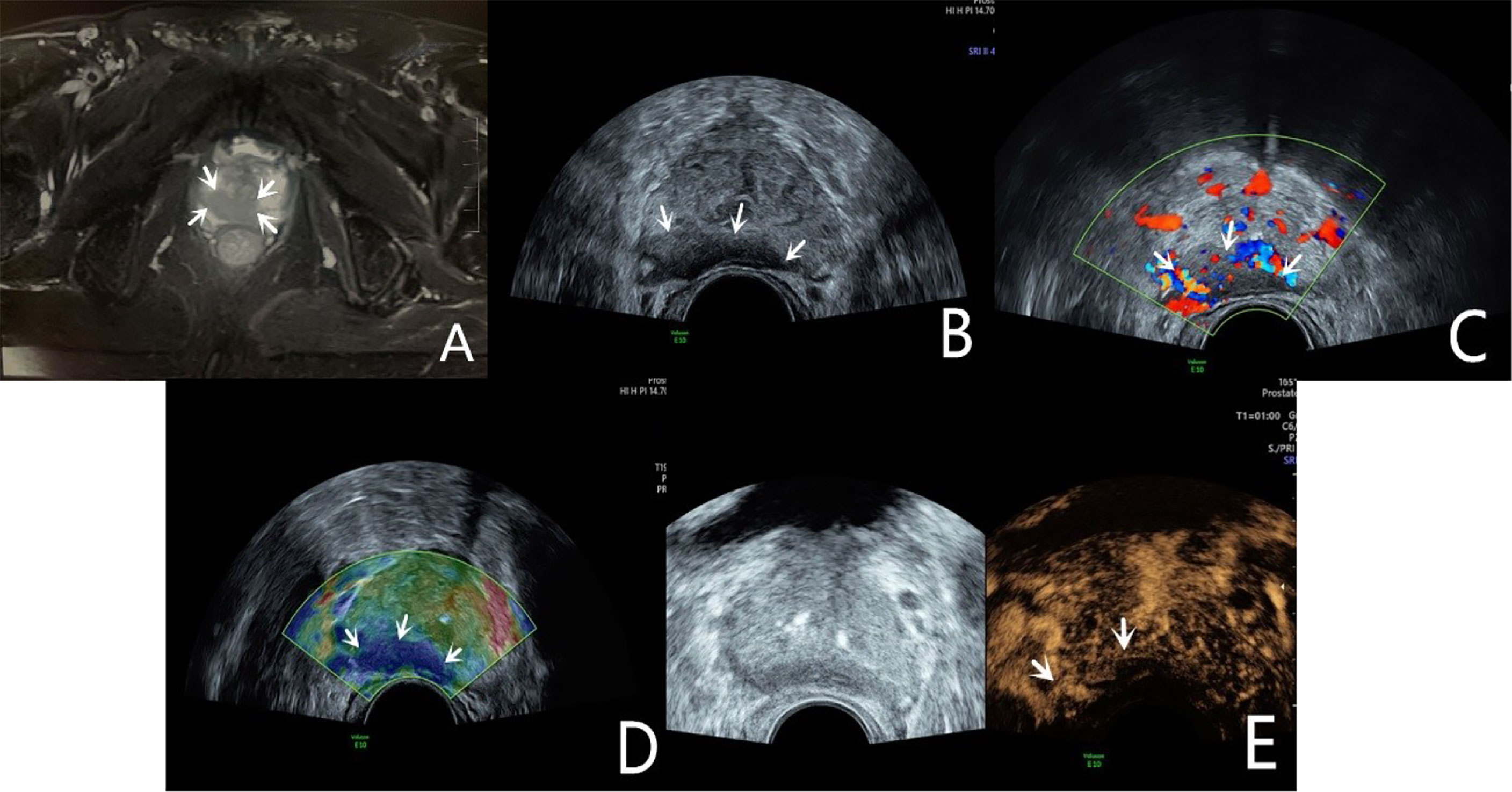 Frontiers Application Of Multiple Ultrasonic Techniques In The Diagnosis Of Prostate Cancer