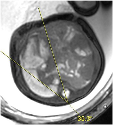 Frontiers  Mediastinal Shift Angle in Fetal MRI Is Associated