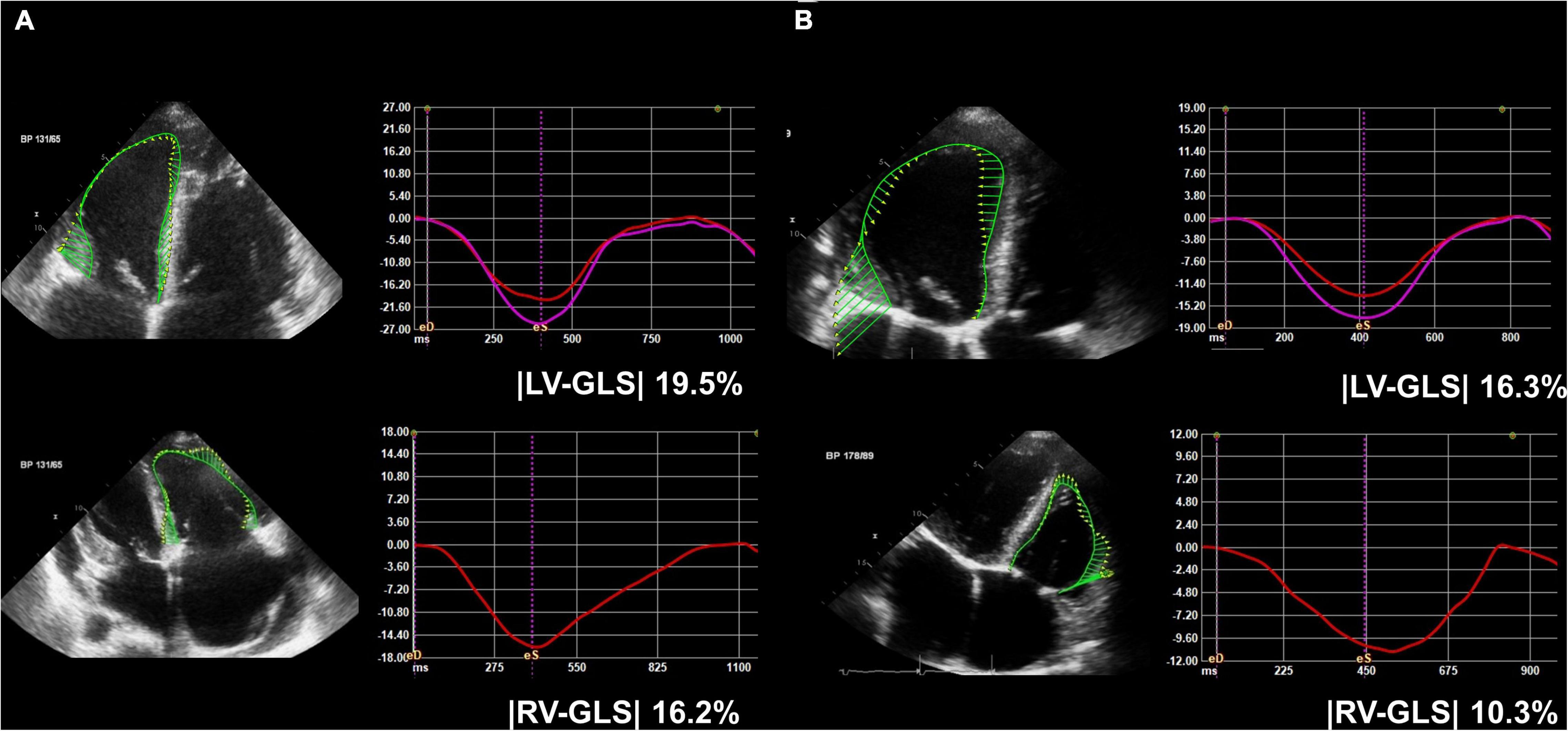Braz J Cardiovasc Surg - Preoperative Left Ventricular Global Longitudinal  Strain Identifies Aortic Stenosis Patients with Improved Postoperative  Recovery of Left Ventricular Geometry: A Prospective Cohort Study