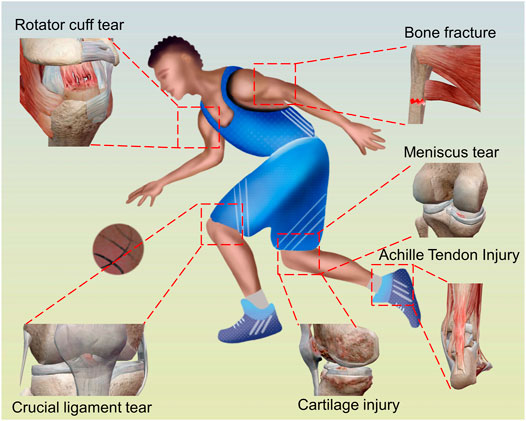 Frontiers | Advances in Regenerative Sports Medicine Research