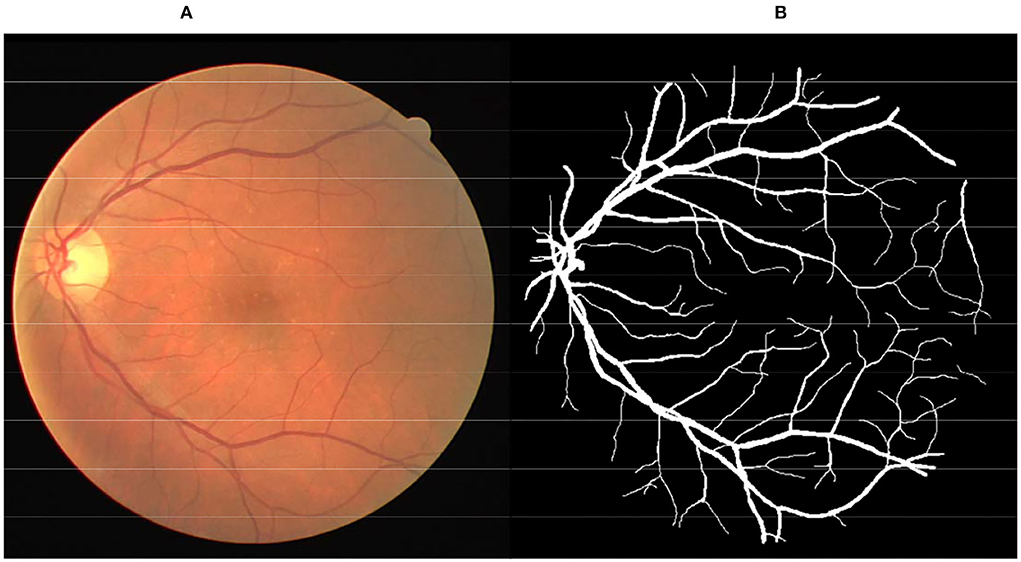 Frontiers | Retinal Vessel Segmentation Based On B-COSFIRE Filters In ...