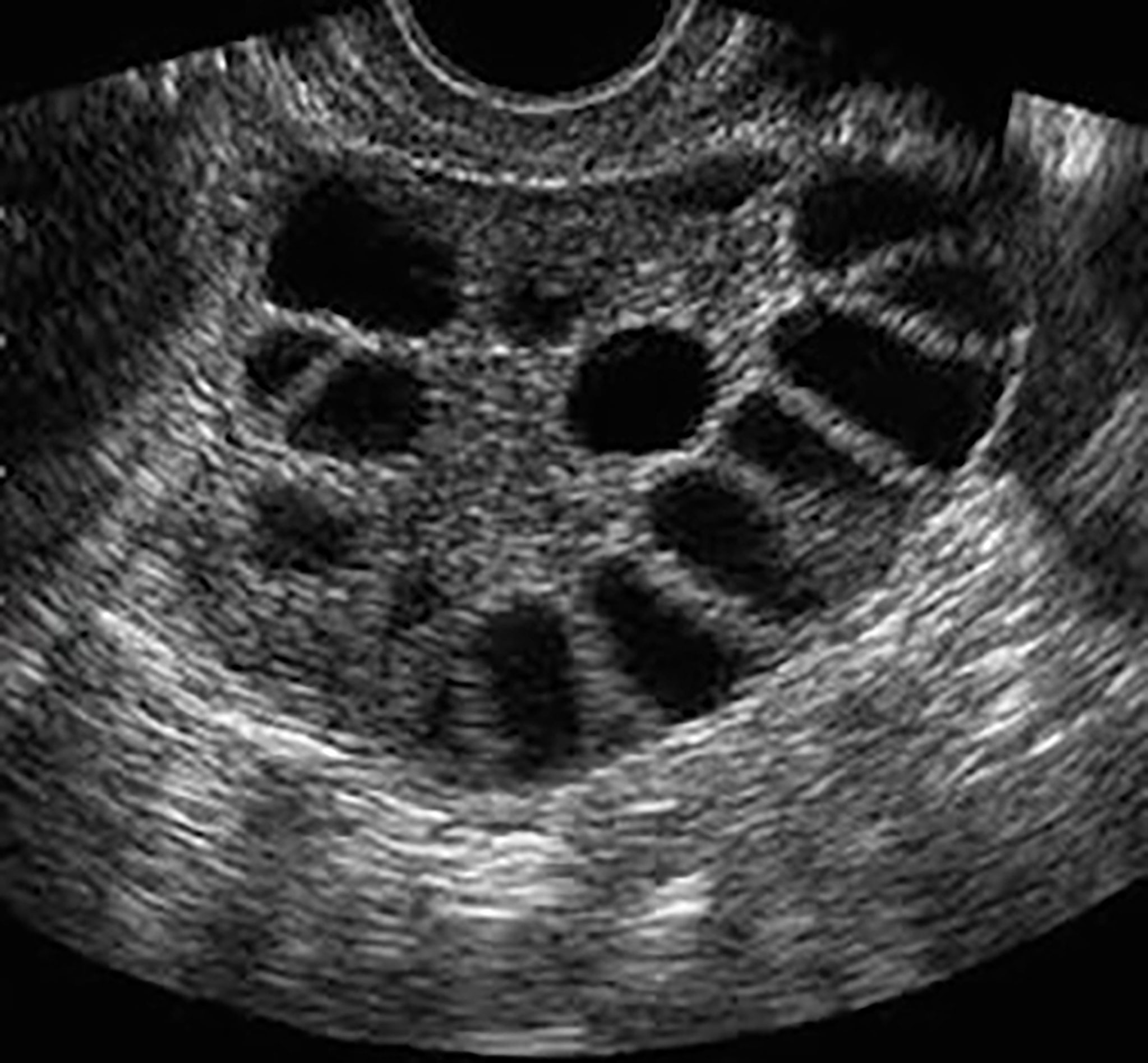 Frontiers Application of a new ultrasound criterion for the diagnosis