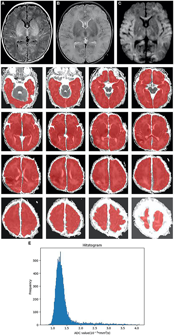 Frontiers | Whole-volume ADC histogram of the brain as an image ...