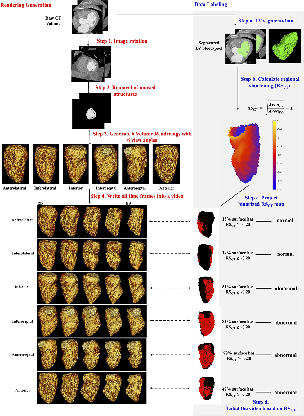 Cardiac wall motion abnormalities, Radiology Reference Article