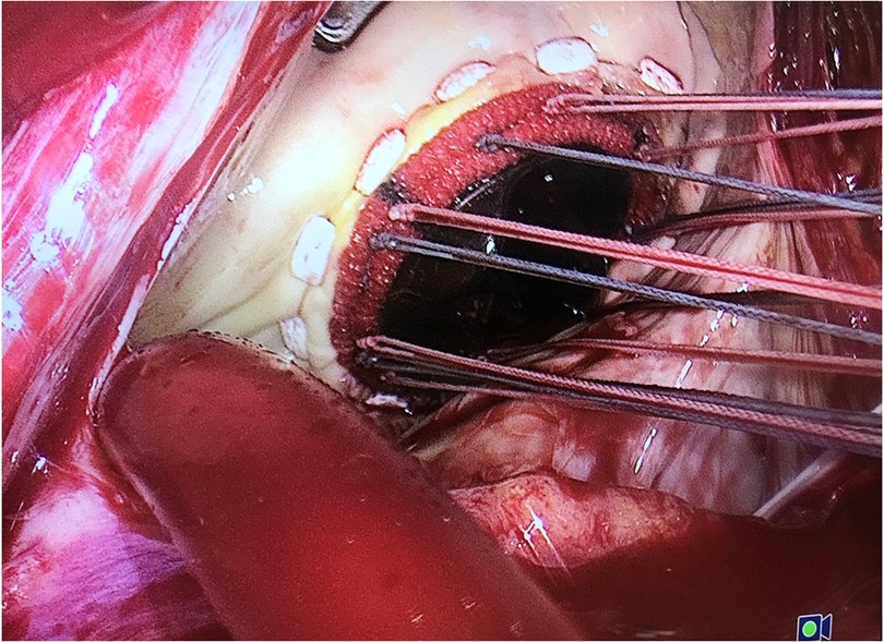 Frontiers  A novel bidirectional side exiting pledgetted suture