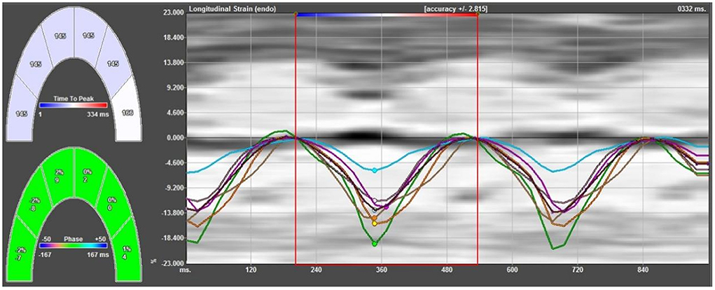 Second trimester ultrasound: reference values for two-dimensional speckle  tracking-derived longitudinal strain, strain rate and time to peak  deformation of the fetal heart.