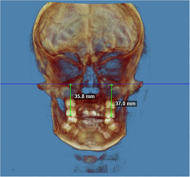 PDF] Evaluation of horizontal condylar angle in malocclusions with  mandibular lateral displacement using cone-beam computed tomography.