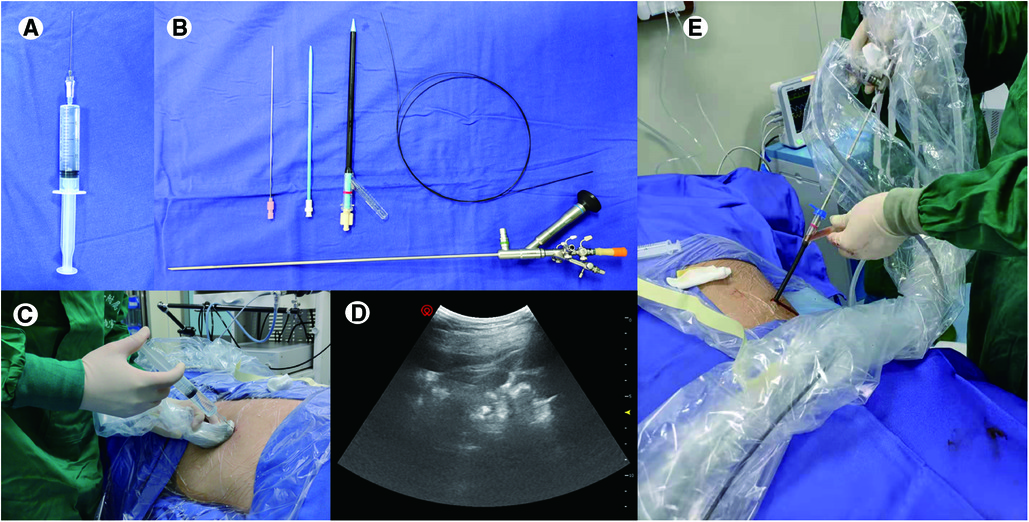 Frontiers Performing Percutaneous Nephrolithotomy Under Modified