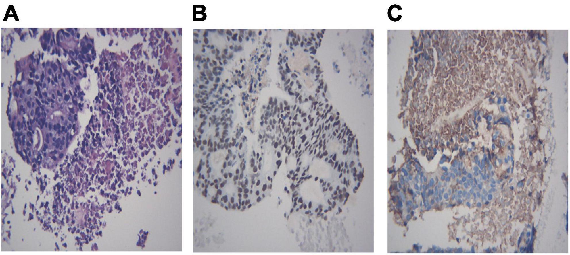 Frontiers | Value Of Transbronchial Needle Aspiration Combined With A ...