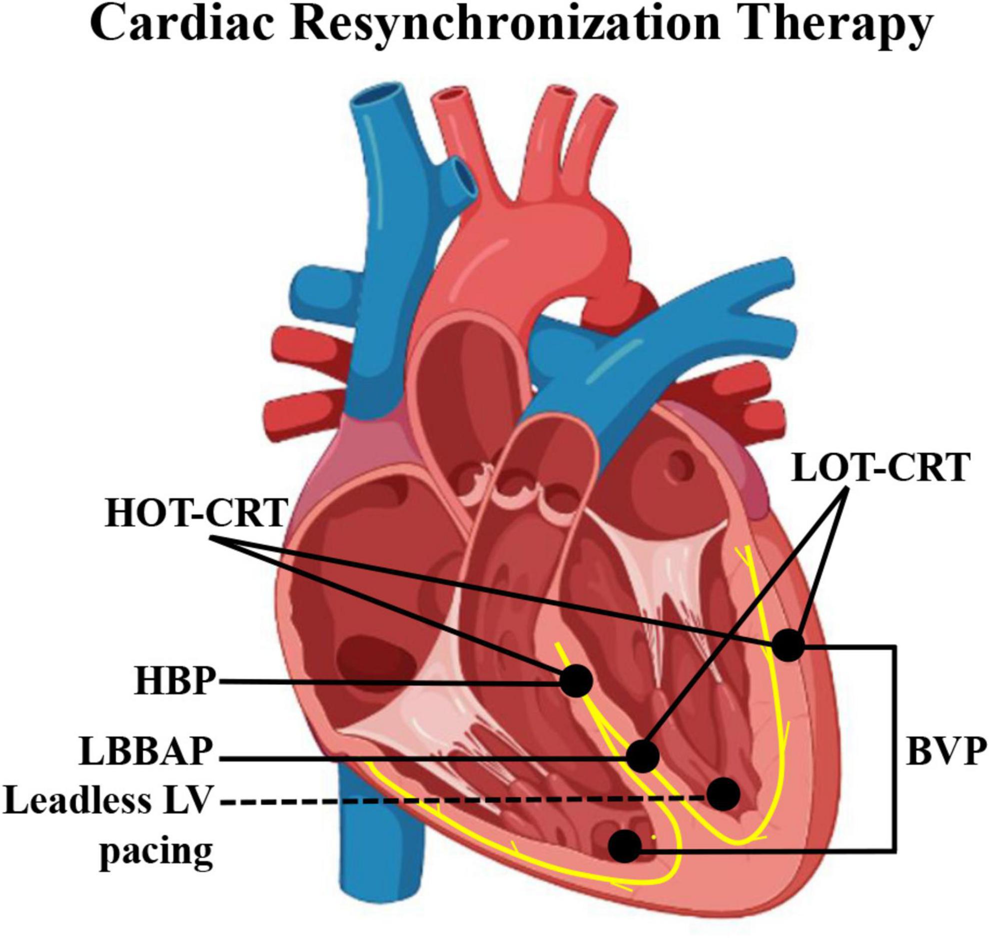 cardiac resynchronization therapy ecg