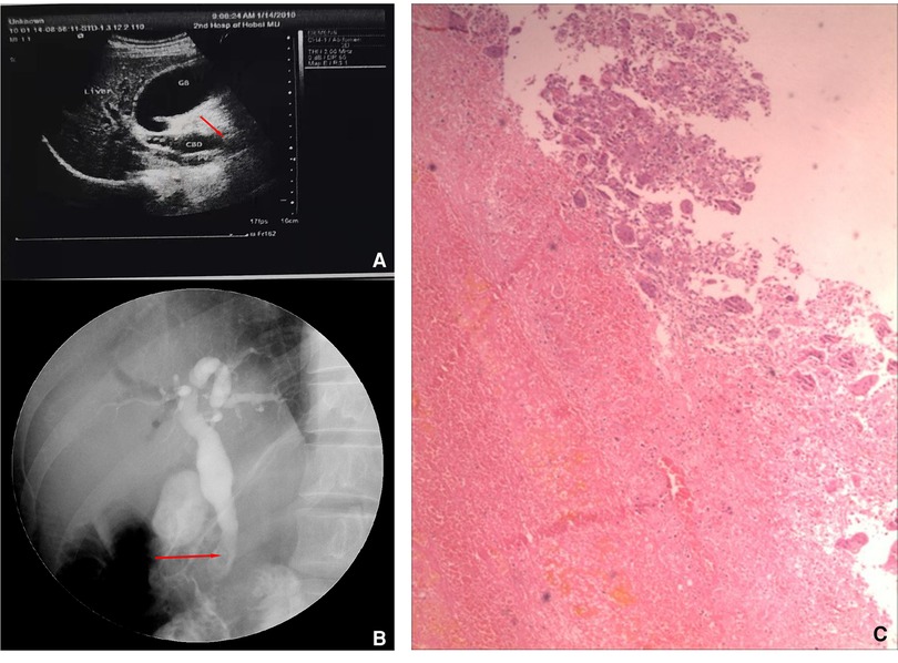 Frontiers | Undifferentiated Pleomorphic Sarcoma of the Duodenal
