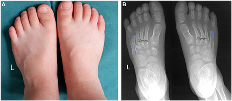 Frontiers | On-Top Plasty at the Level of the Metatarsal Neck for ...