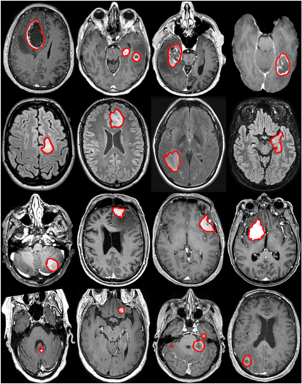 brain tumor mri without contrast
