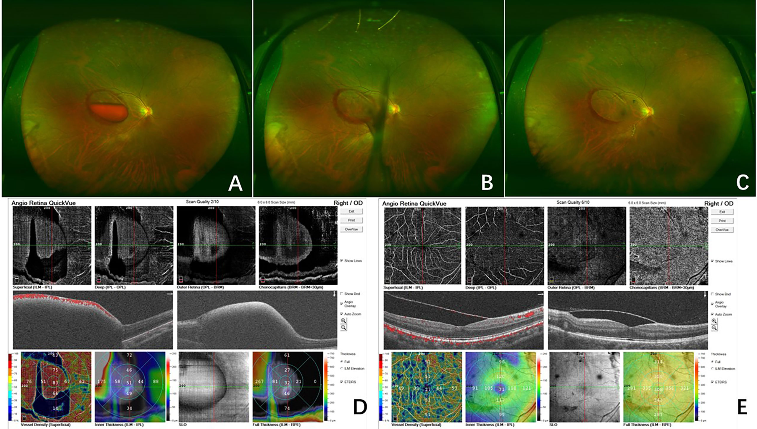 RETINA SPARGIFIAMMA DIAM 20CM