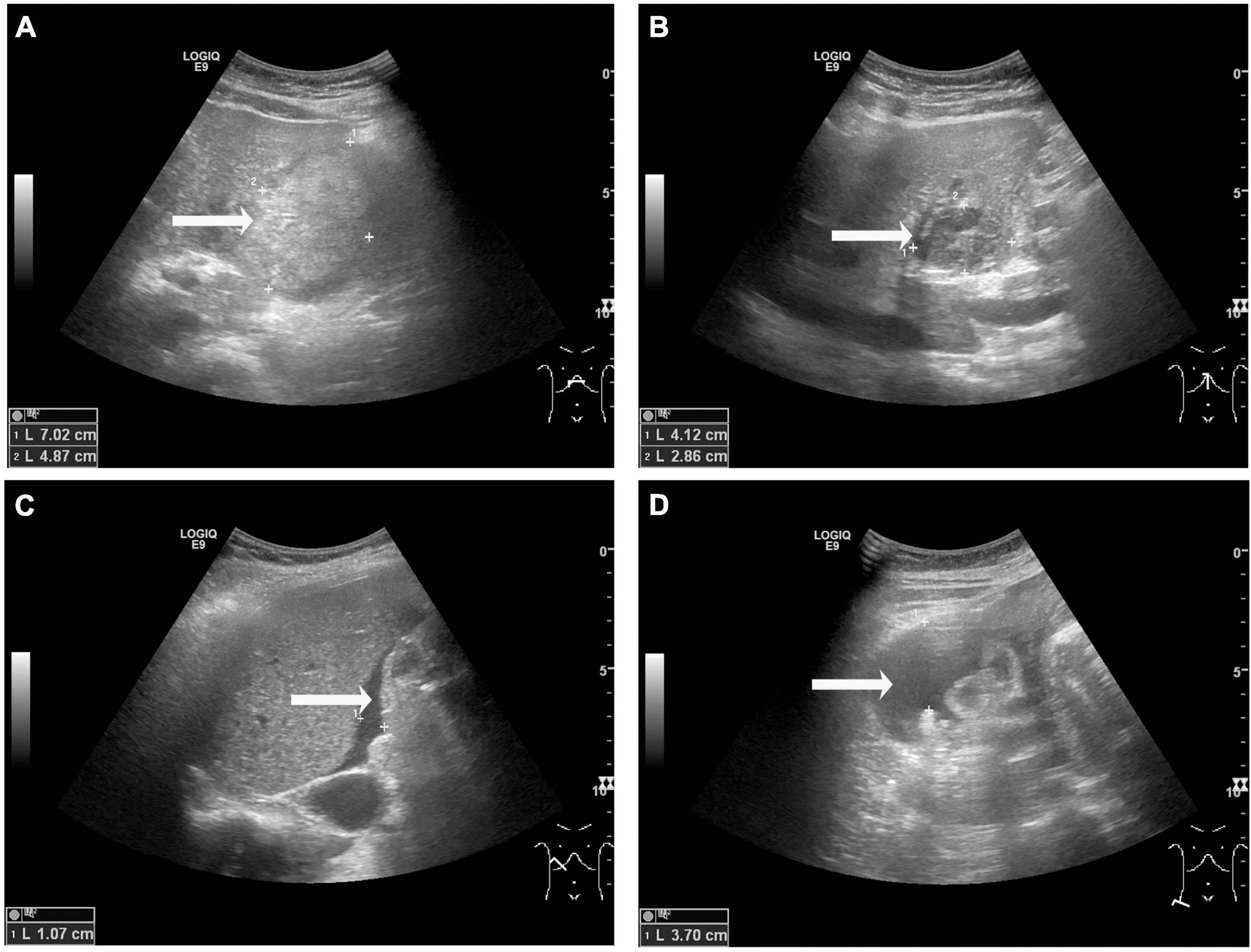 Frontiers Spontaneous Hepatic Rupture During Late Pregnancy In A