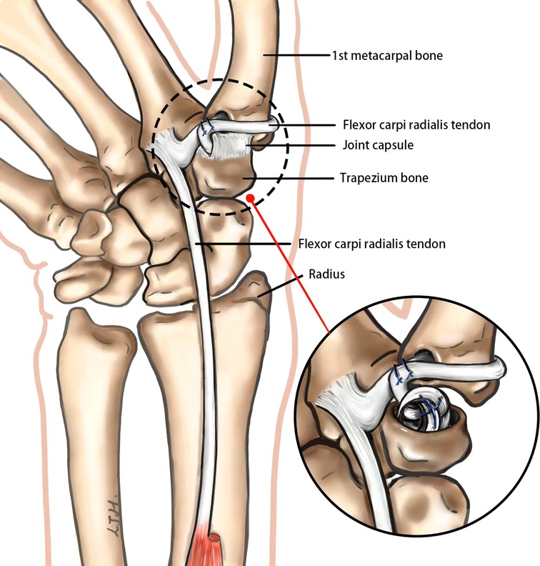 Frontiers Arthroscopy assisted Partial Trapeziectomy Combined With 