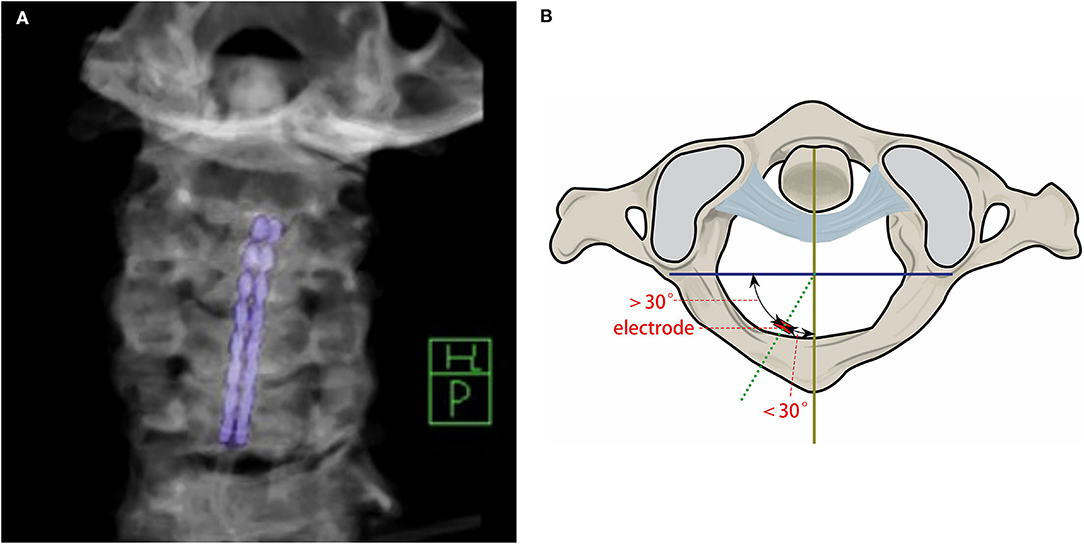 Functional Electrical Stimulation in Standing to Treat Decreased Bone  Mineral Density After Spinal Cord Injury – Adult and pediatric printable  resources for speech and occupational therapists