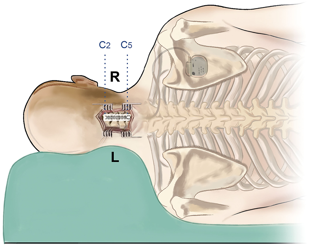 Functional Electrical Stimulation in Standing to Treat Decreased Bone  Mineral Density After Spinal Cord Injury – Adult and pediatric printable  resources for speech and occupational therapists