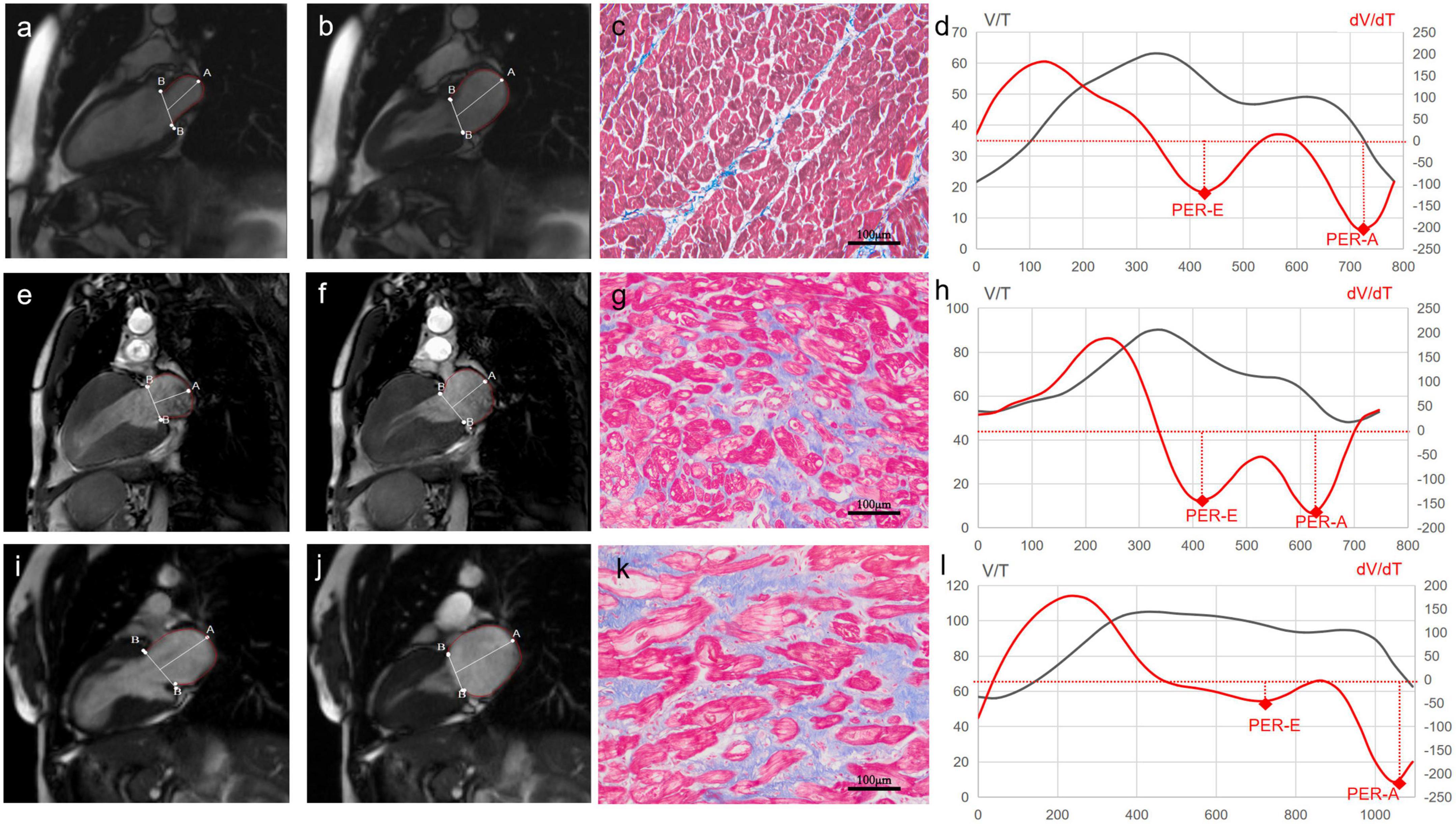 Frontiers Sex Differences In Atrial Remodeling And Its Relationship With Myocardial Fibrosis